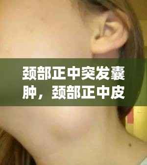 颈部正中突发囊肿,颈部正中皮下囊肿图片