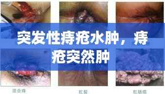 突发性痔疮水肿,痔疮突然肿